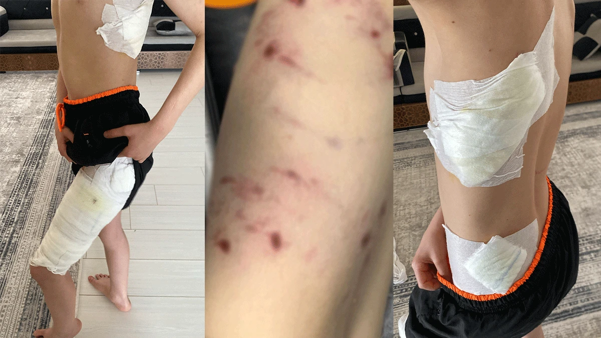 Karaköprü’de küçük çocuk sokak köpeklerinin saldırısına uğradı
